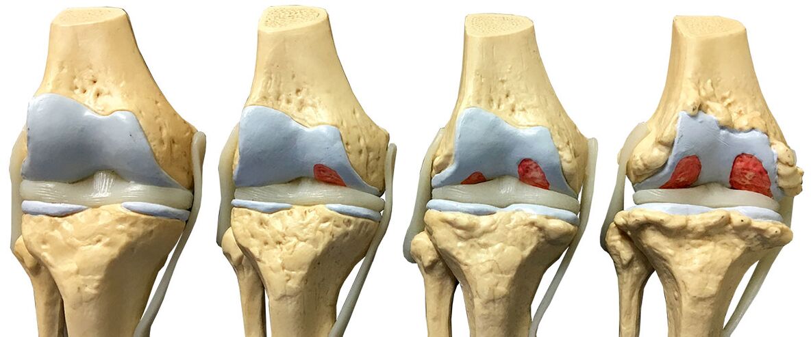 Knee articulation arthrosis stages