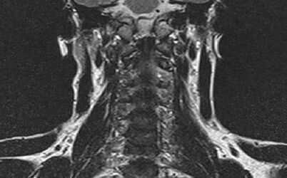 The cervical spine