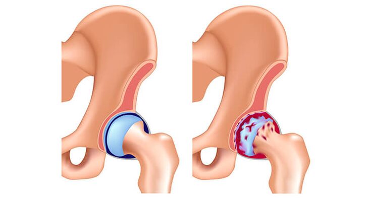 Hip Articulation Arthrosis